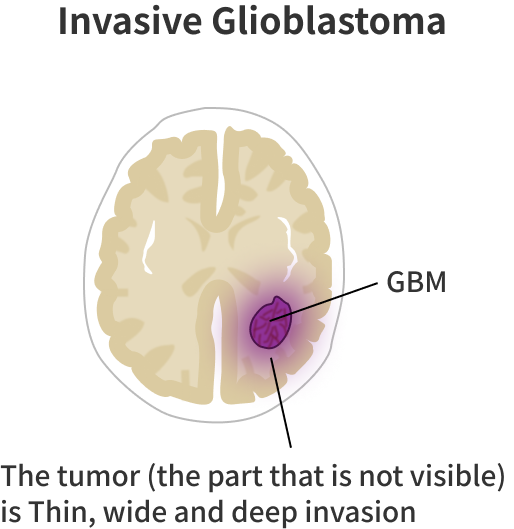 グリオブラストーマの浸潤
